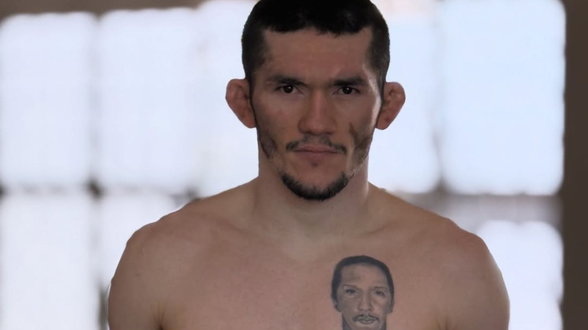 Melquizael Costa Skin Condition/disease Vitiligo UFC